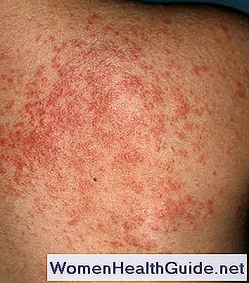 Malattia termica (eccesso di calore corporeo)