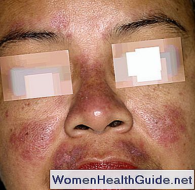 Come diagnosticare il Lupus (SLE)? Sintomi e test