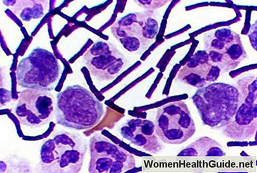 Infezione umana di antrace (Bacillus anthracis)