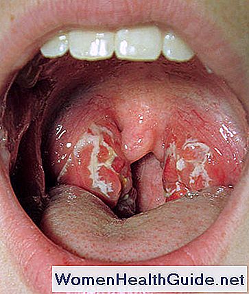 Come prevenire la tonsillite ricorrente nei bambini e negli adulti