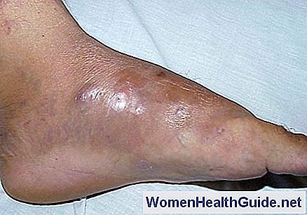Nocardiosi (infezione da Nocardia Asteroides - pelle, polmoni, cervello)