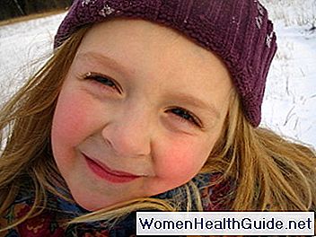 Guance rosse, Malar Rash e Flushing of the Cheek (Rossore)