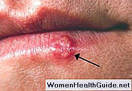 5 Anzeichen von Herpes (Oral und Genital), erste Symptome, Bilder
