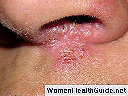 Herpes nariz causas