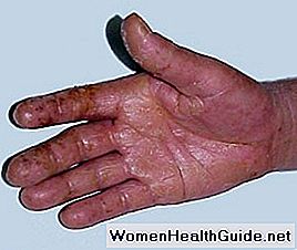 Prurito e rash tra cause di dita, trattamenti